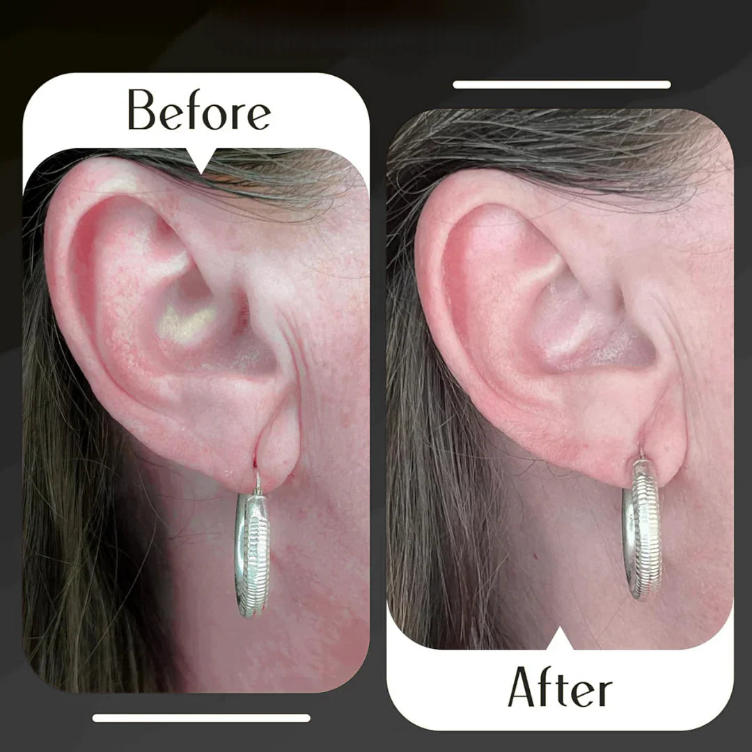 Rareskin™ EarLobe Support Patches (100 PCS)